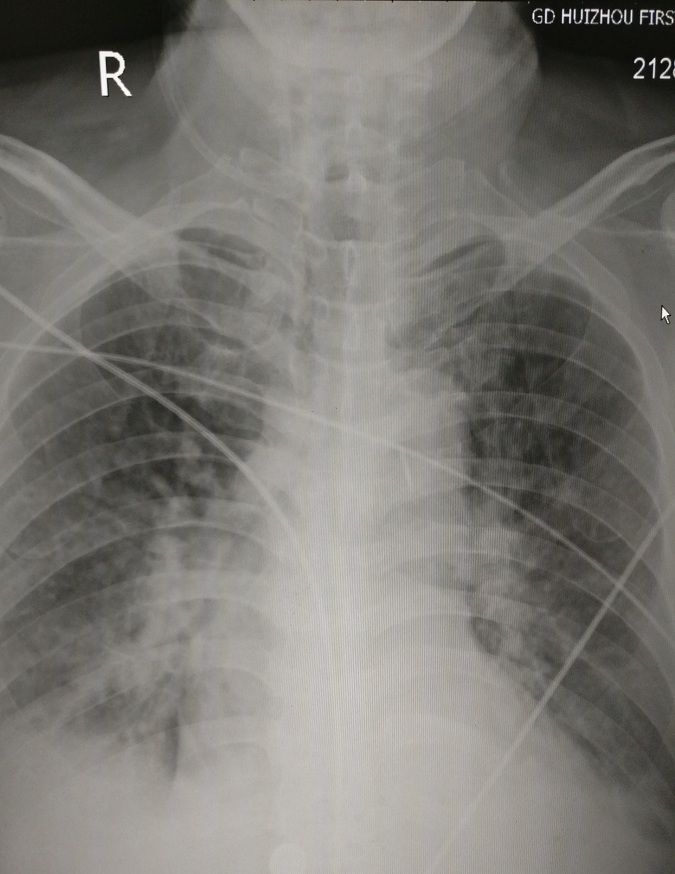 循环系统胸片,体循环和肺循环临床表现