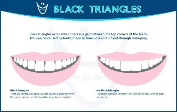牙齿黑三角怎么补救,牙齿上的黑三角怎么改善