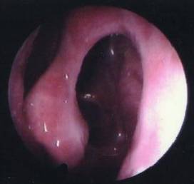 慢性鼻窦炎药物治疗原则,慢性鼻窦炎初步诊疗措施