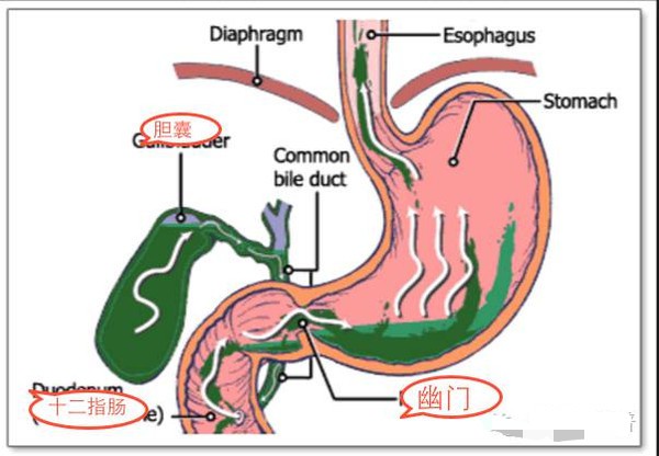幽门失守，胆汁反流兴风作浪，医生：这种病想治好需改善生活习惯