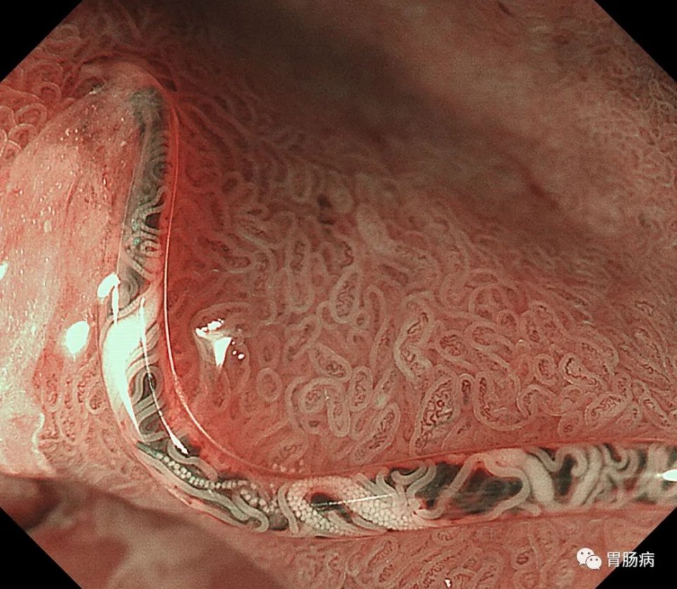 腹痛查不出病因全部检查都做了,腹痛查不出病因视频