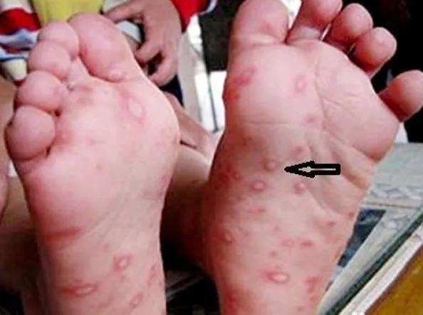 手足口病的预防与护理温馨提示,幼儿手足口病预防知识