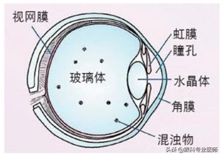 飞蚊症是疾病隐患,飞蚊症可怕不