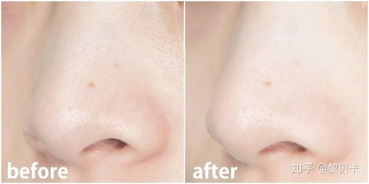 公认最好用的去黑头神器,网红推荐去黑头神器
