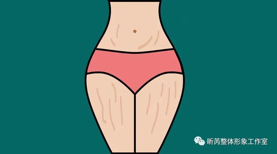 肥胖纹真的是因为肥胖而导致的吗,比胖更可怕的是松弛和下垂