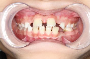 8岁的孩子能做牙齿矫正吗,7岁孩子矫正牙齿早吗