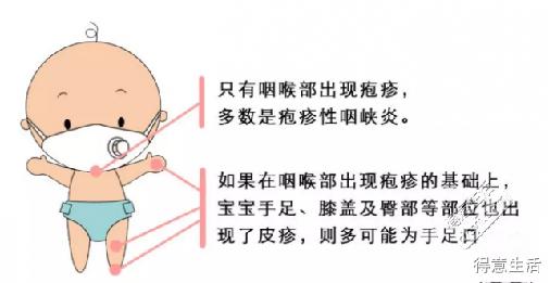 宝宝得疱疹性咽峡炎怎么办,疱疹性咽峡炎和手足口区别