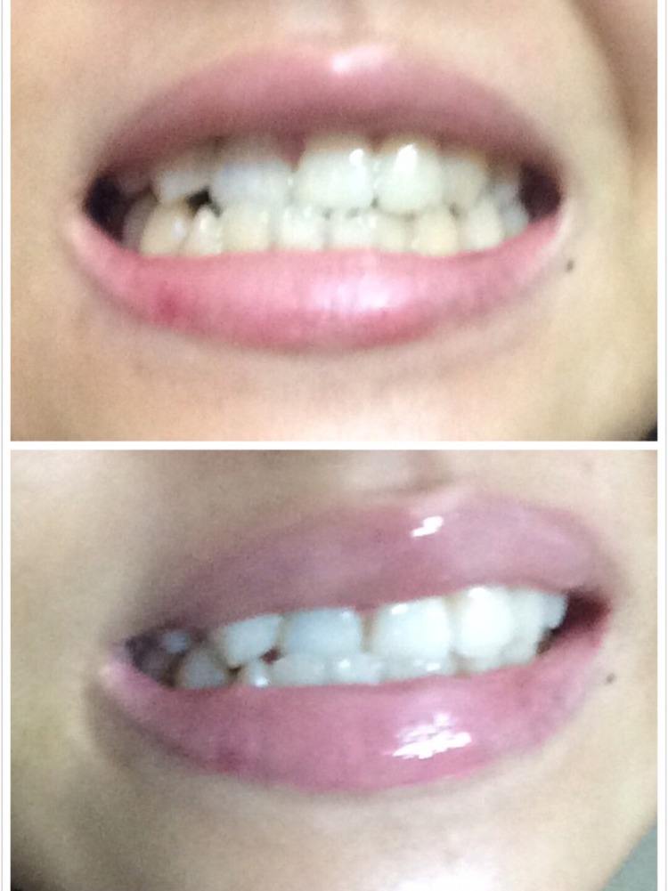 牙黄口臭怎么办用什么牙膏,黄牙口臭解决方法牙膏