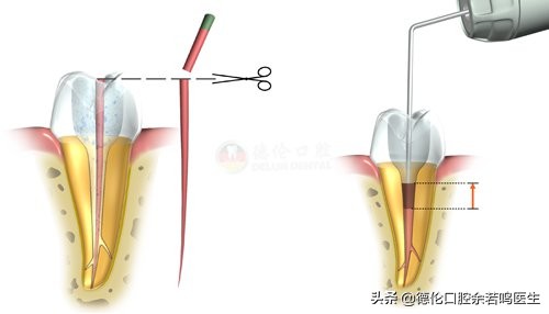 现在修复牙齿有哪几种类型的牙,牙齿修复的几种方法和价格