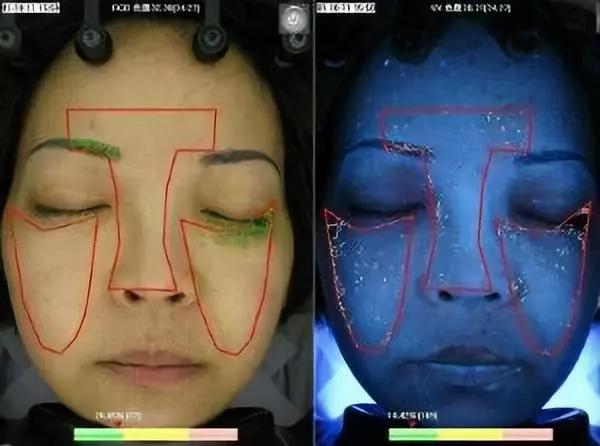 别再用针挑！用米澳拉，脂肪粒自己“掉”下来，效果胜过医美激光