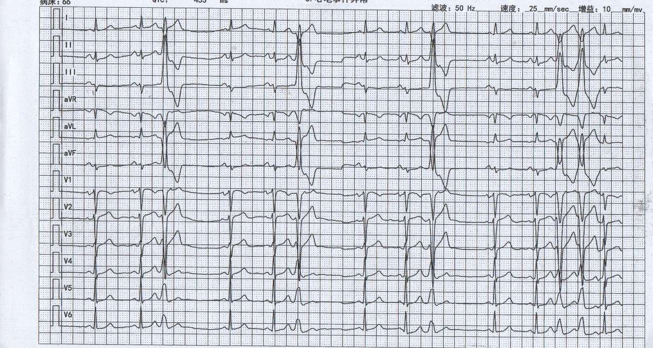 插入性室早的危害,室早什么引起的