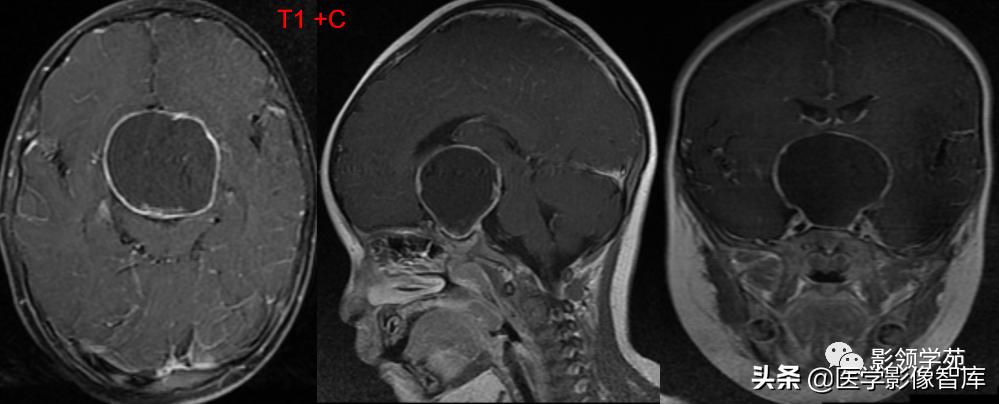 鞍区肿瘤做什么检查得出来,鞍区肿瘤的影像学鉴别