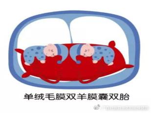 双胎妊娠分娩期并发症,双胎妊娠分娩注意事项