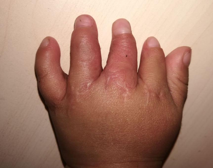 并指畸形免植皮案例,并指畸形