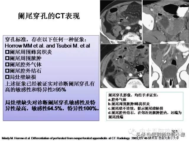 阑尾炎课件,阑尾炎的超声课件