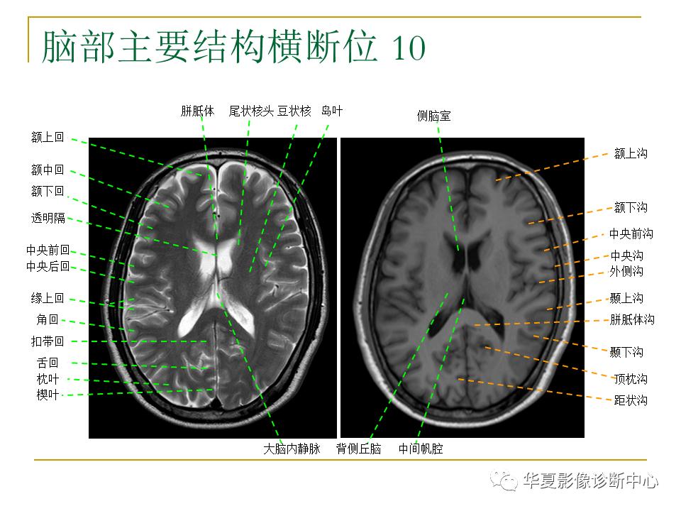 中国人脑立体定向mri应用解剖图谱,脑mri示意图
