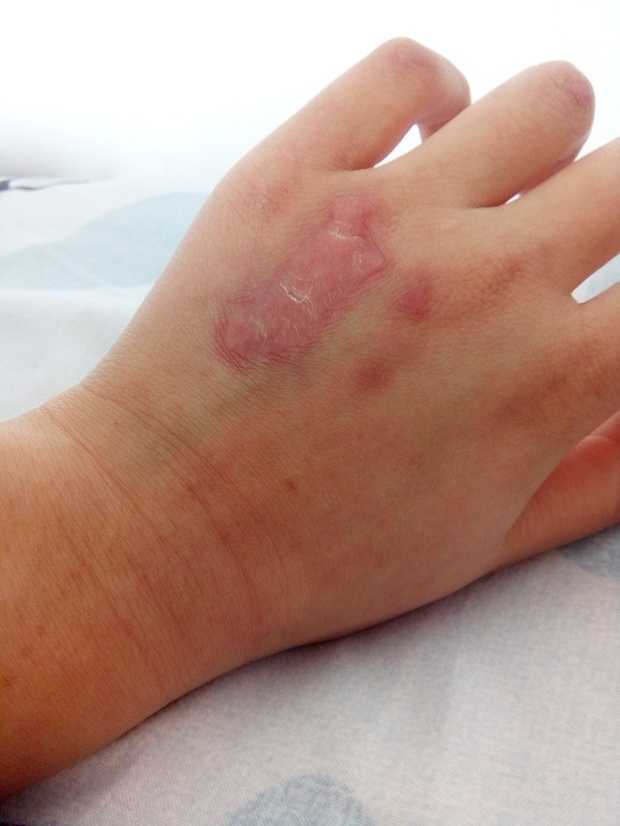 疤痕疙瘩淡化颜色的方法,氢醌乳膏能祛除疤痕红印吗