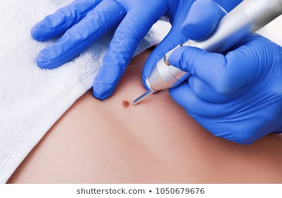 哪些痣医生建议不能祛除,痣对健康有什么威胁如何治疗