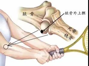 为什么不会打网球还能患上网球肘,不打网球的人会患上网球肘吗