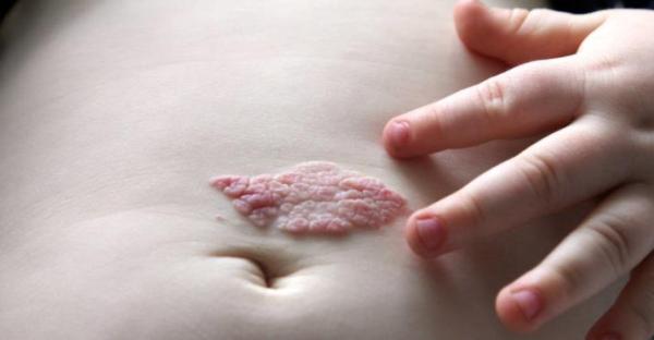 小孩身上出现红色印记,儿童身上有红色印记