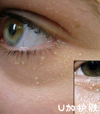 眼部脂肪粒图片大全,眼部脂肪粒去除小窍门是什么原理