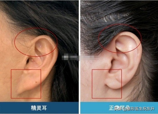 面部小拉皮手术提升效果和视频,面部提升手术和拉皮手术是一样吗