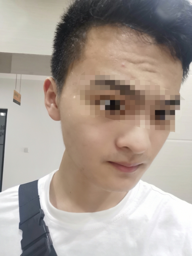 背部痘印黑色素沉淀怎么去除,痘痘痘印怎么去除