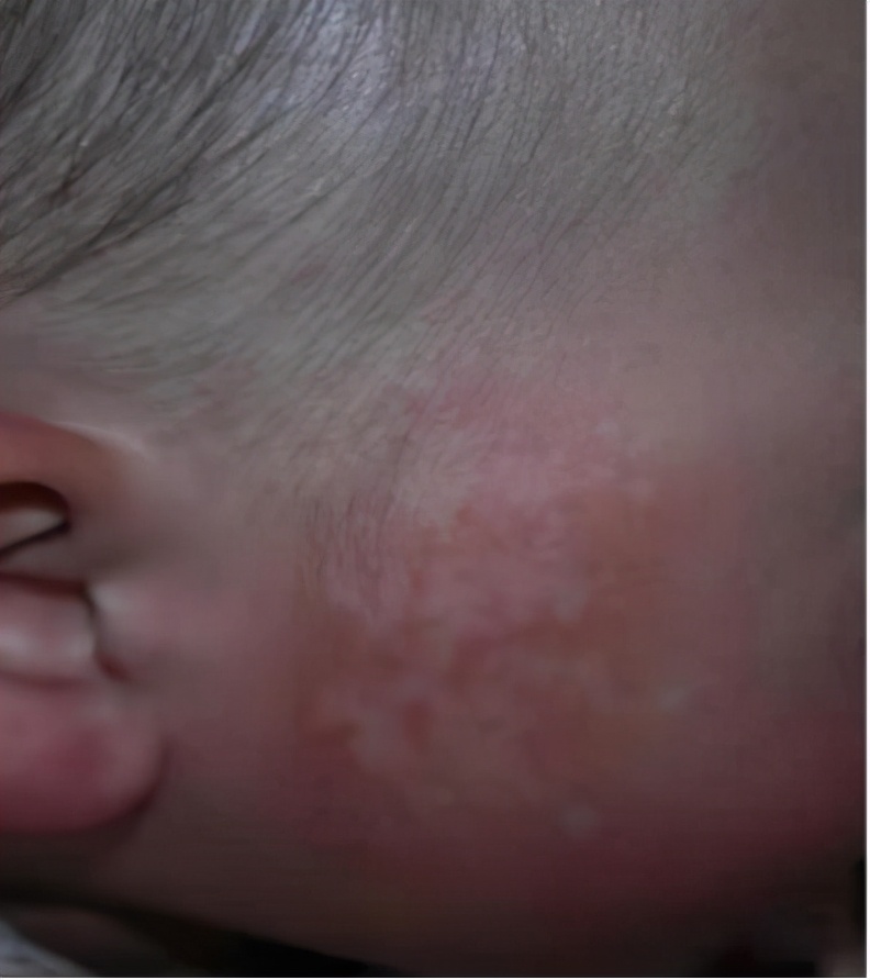 白斑是白癜风还是糠疹如何鉴别呢,宝宝脸上有白斑是脾胃虚吗