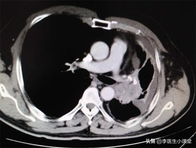 肺癌晚期双腿无法走路,肺癌晚期出现双腿栓塞怎么办