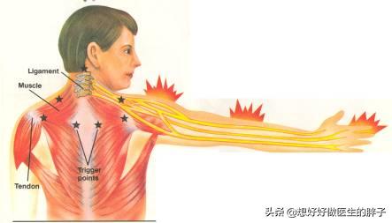 肩颈椎疼怎么办最快最有效,颈椎肩周痛有什么办法解决