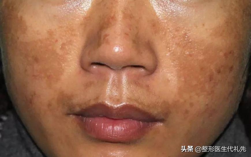 褐斑成因,褐斑的形成原因和治疗方法
