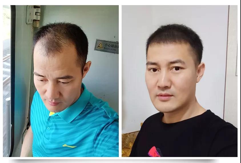 自体毛囊植发怎么植,自体毛发植发价格