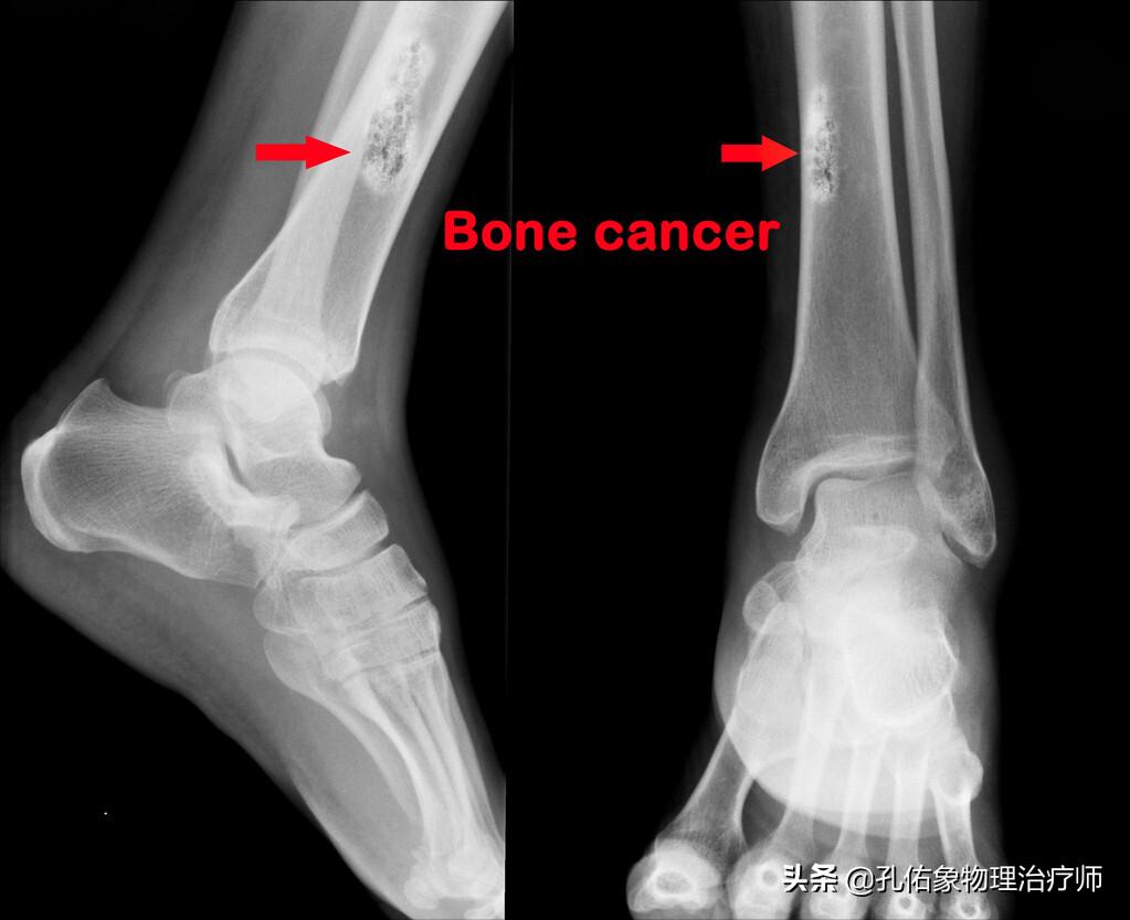 睡觉腿抽筋除了缺钙还有3个原因,睡觉突然腿抽筋是缺钙正确答案
