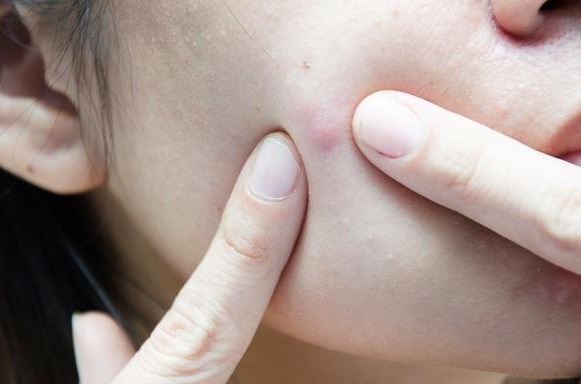 爱长痘的护肤品推荐,爱长痘推荐什么牌子抗老的护肤品