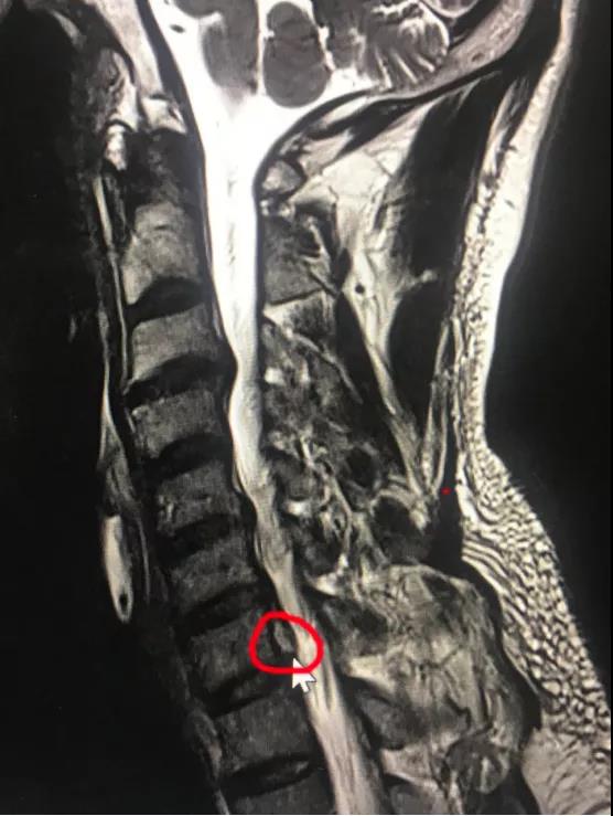 *安泰**市中心医院成功开展颈椎后路内镜“钥匙孔”技术治疗高度游离的颈椎间盘突出症