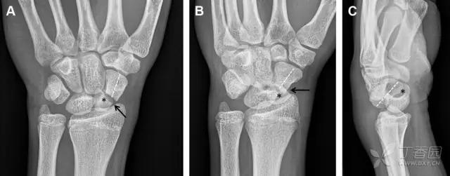 值夜班急救措施,放射科容易漏诊的骨折