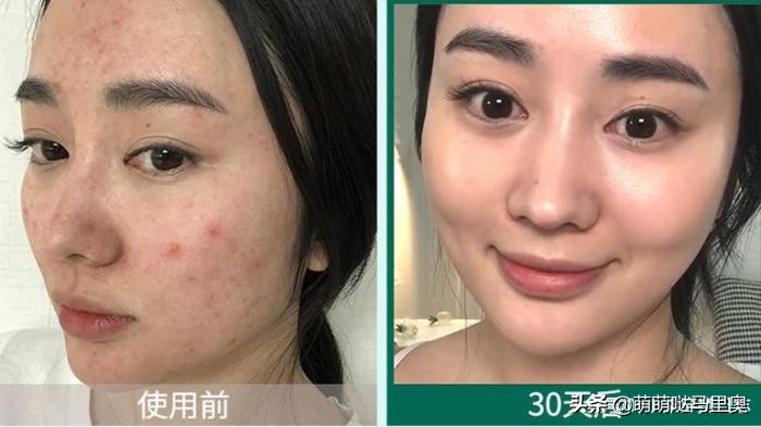 祛痘强效药,超好用的祛痘方法