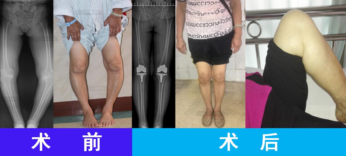 膝关节骨性关节炎症状及治疗,膝关节骨性关节炎诊疗指南下载