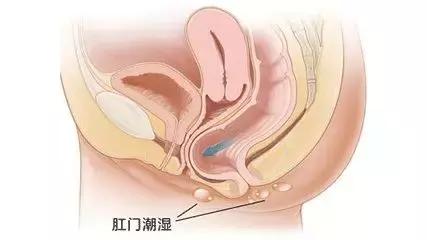 有痔青年如何远离痔疮,刚得痔疮怎样根治痔疮