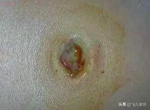 新生儿脐带发红怎么处理,新生儿脐带还没掉有臭味周围发红