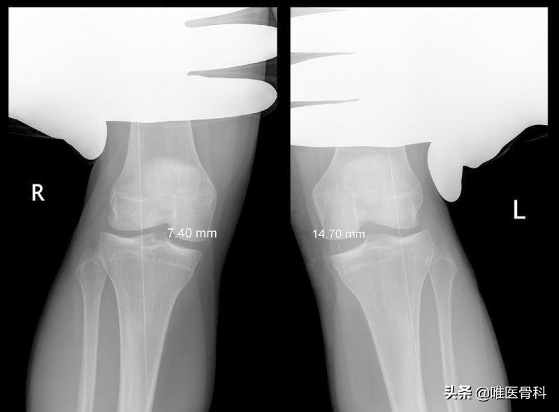 膝关节内侧副韧带损伤的诊疗进展,膝关节内侧副韧带损伤的正确叙述