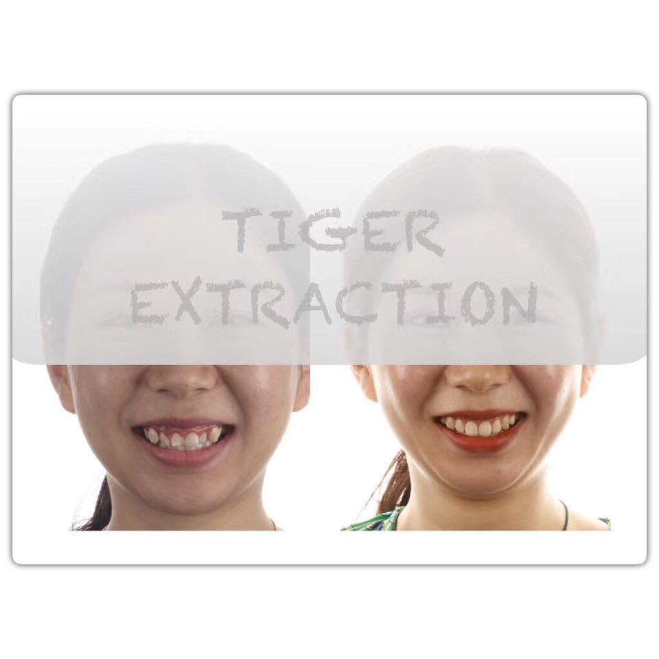 隐适美矫正网上为什么这么便宜,隐适美矫正会不会比预期的快