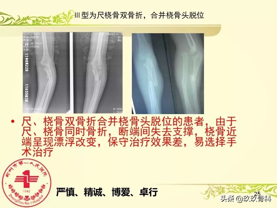 孟氏骨折功能训练多久能恢复正常,孟氏骨折中医能治吗