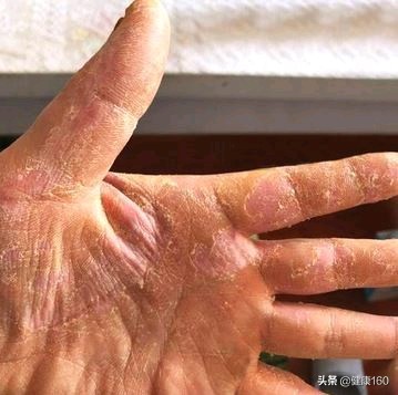 手脱皮考虑什么诊断,手脱皮有哪几种类型