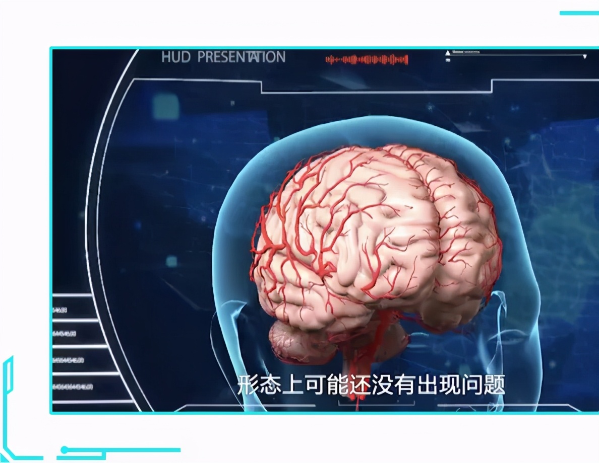 40多岁记忆力下降是痴呆的征兆吗,怎么分辨记忆力下降和老年痴呆