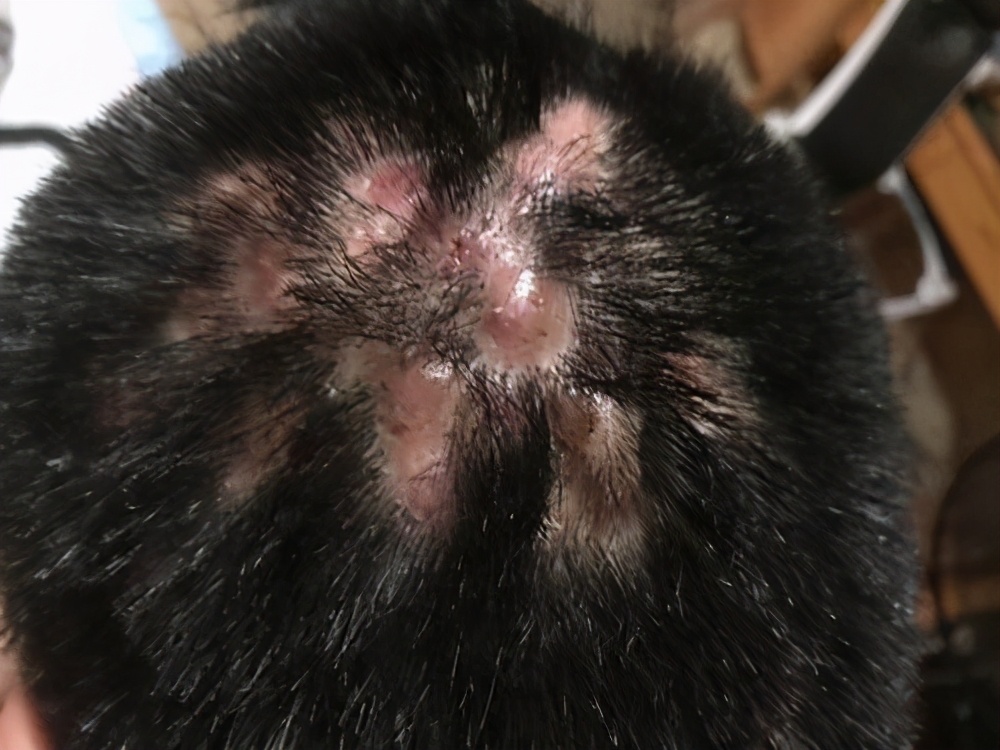 穿掘性毛囊炎喝中药多久能好,治疗穿掘性毛囊炎最好的医院