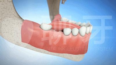 种植牙是什么种植技术,种植牙一般要怎么种植的