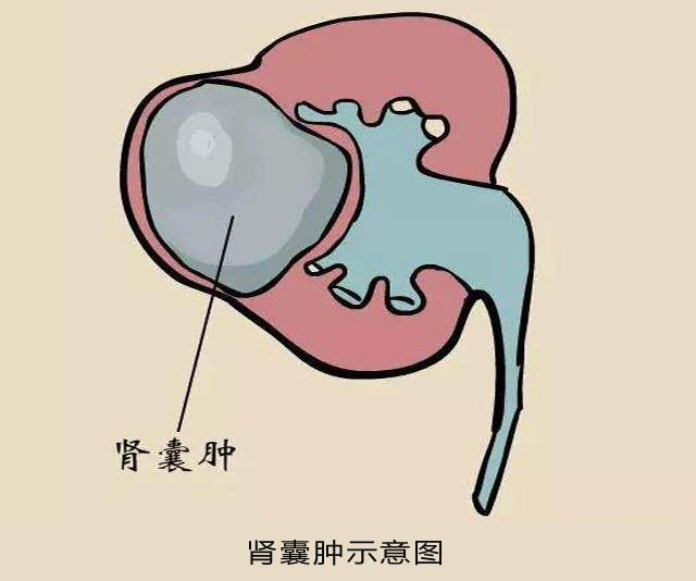 肾囊肿在什么情况下变癌,肾囊肿的原因和结局