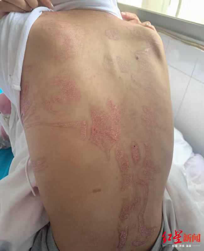 美容院拔火罐能改善哪些问题,拔火罐能美容养颜吗