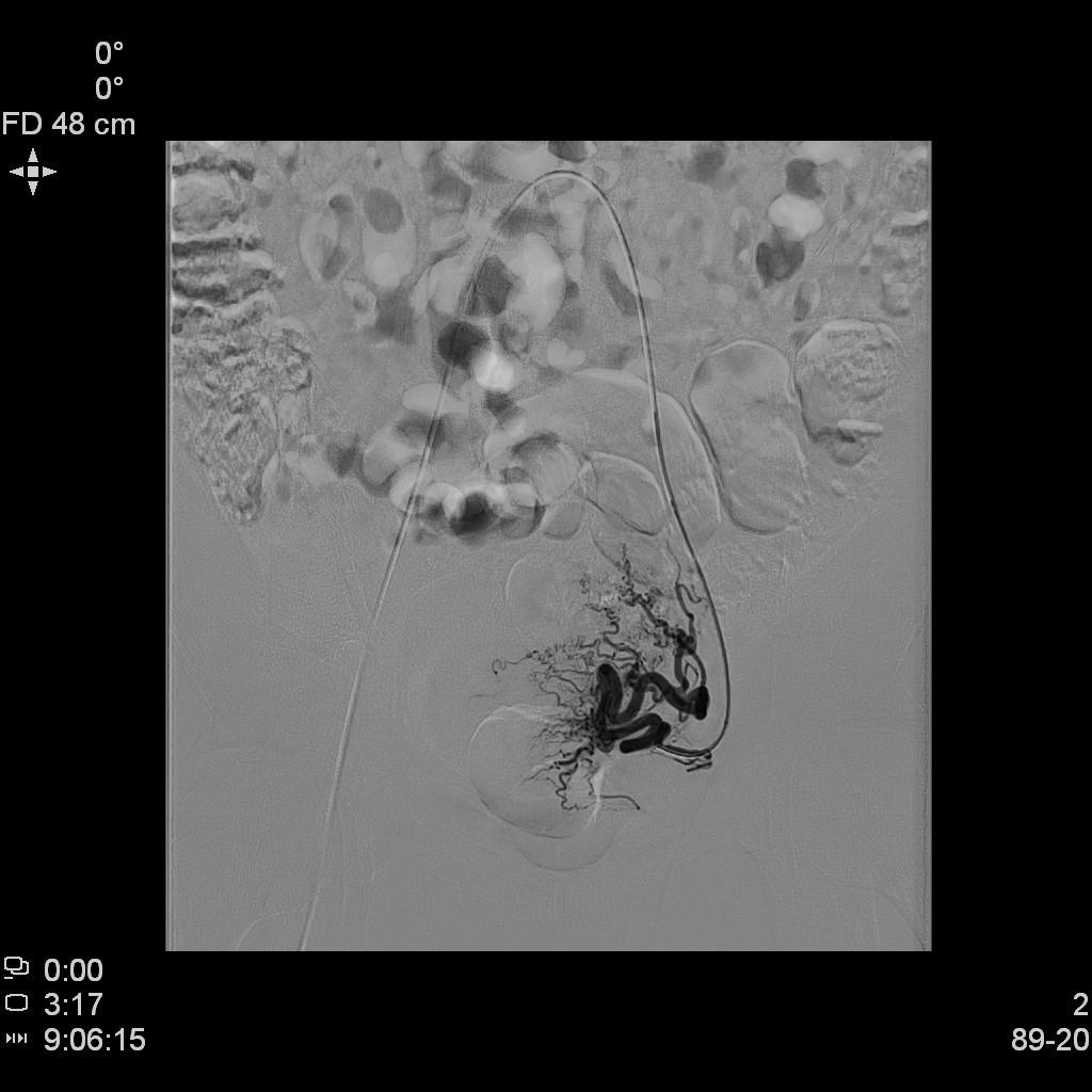 子宫肌瘤不能开刀只能化疗严重吗,子宫肌瘤介入栓塞治疗后注意事项